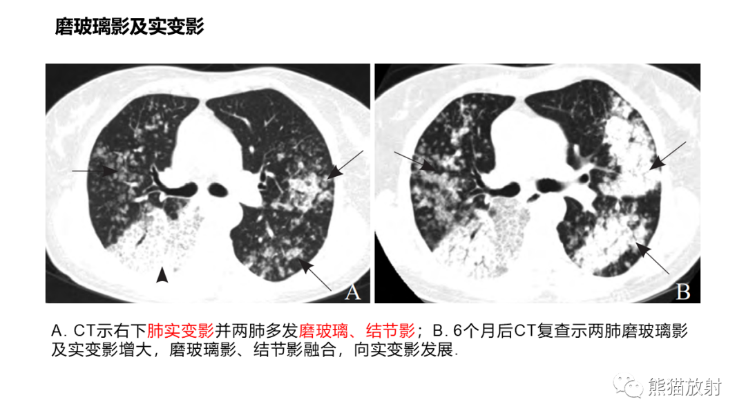 影像PPT - 【病例】肺炎型肺癌 VS 肺组织慢性炎-19