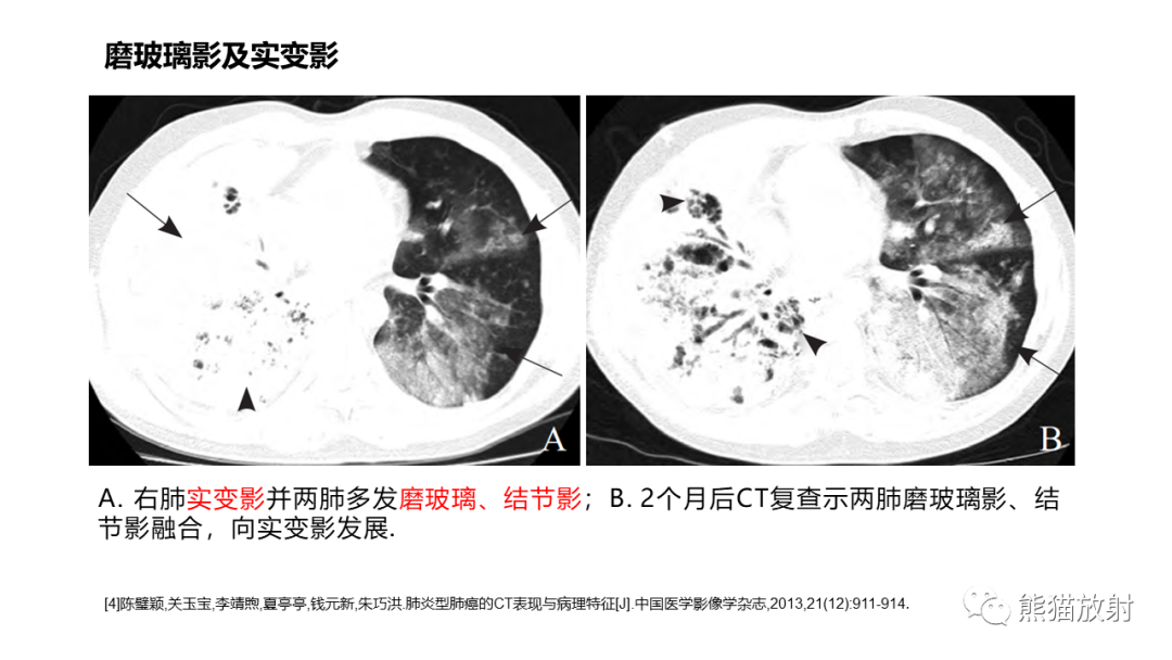 影像PPT - 【病例】肺炎型肺癌 VS 肺组织慢性炎-18