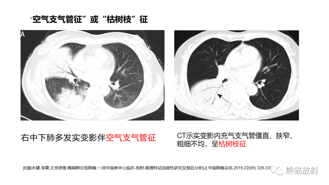 影像PPT - 【病例】肺炎型肺癌 VS 肺组织慢性炎-21