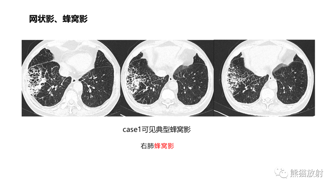 影像PPT - 【病例】肺炎型肺癌 VS 肺组织慢性炎-22