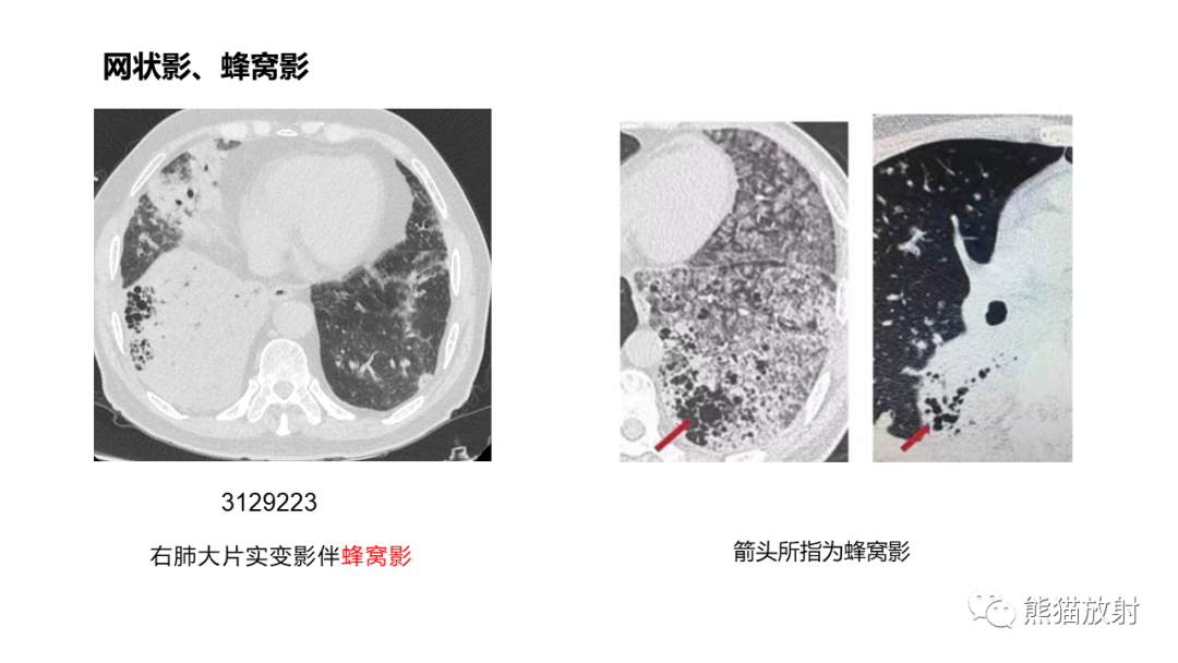 影像PPT - 【病例】肺炎型肺癌 VS 肺组织慢性炎-23