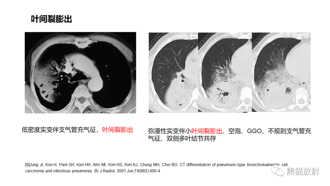 影像PPT - 【病例】肺炎型肺癌 VS 肺组织慢性炎-25