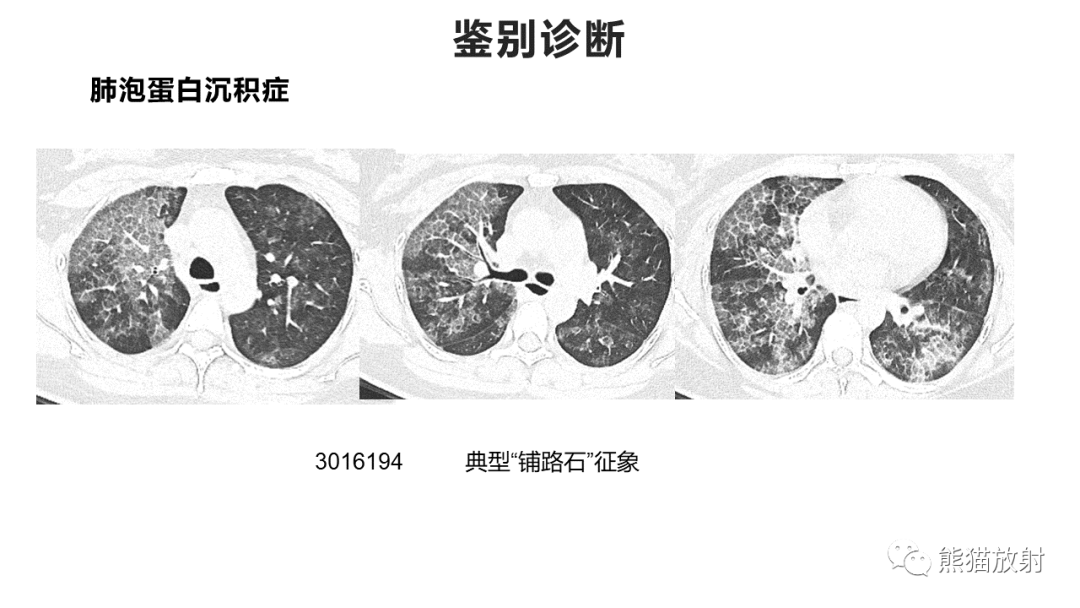 影像PPT - 【病例】肺炎型肺癌 VS 肺组织慢性炎-33