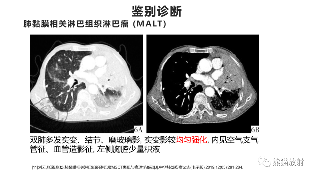 影像PPT - 【病例】肺炎型肺癌 VS 肺组织慢性炎-36