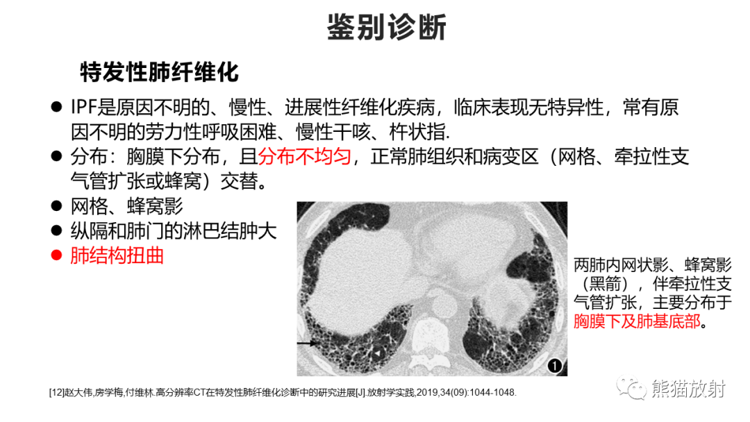 影像PPT - 【病例】肺炎型肺癌 VS 肺组织慢性炎-37