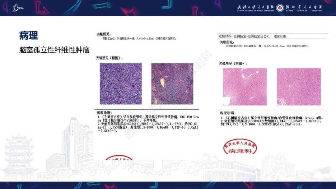 影像PPT - 【PPT】脑室孤立性纤维性肿瘤影像诊断-6