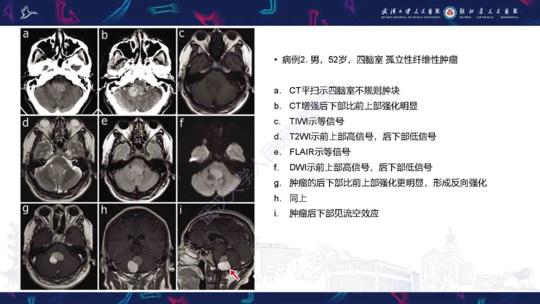 影像PPT - 【PPT】脑室孤立性纤维性肿瘤影像诊断-14