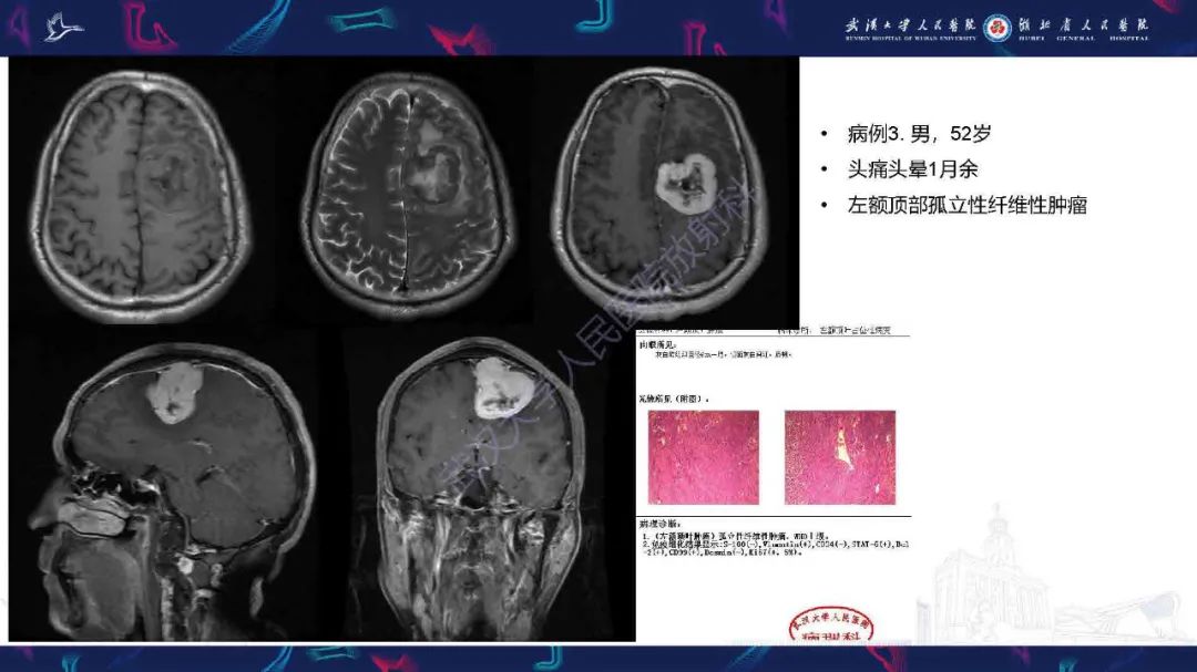 影像PPT - 【PPT】脑室孤立性纤维性肿瘤影像诊断-15