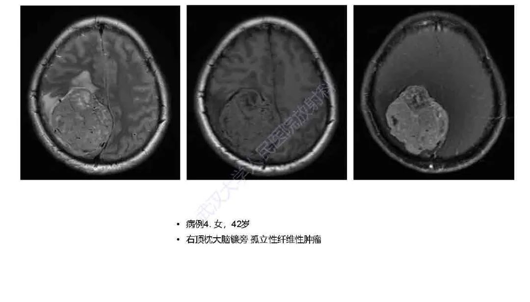 影像PPT - 【PPT】脑室孤立性纤维性肿瘤影像诊断-16