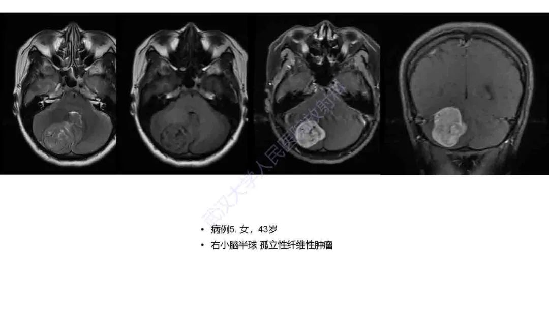 影像PPT - 【PPT】脑室孤立性纤维性肿瘤影像诊断-17