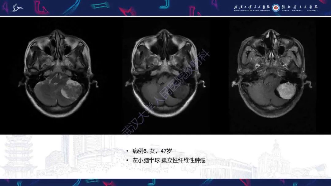 影像PPT - 【PPT】脑室孤立性纤维性肿瘤影像诊断-18