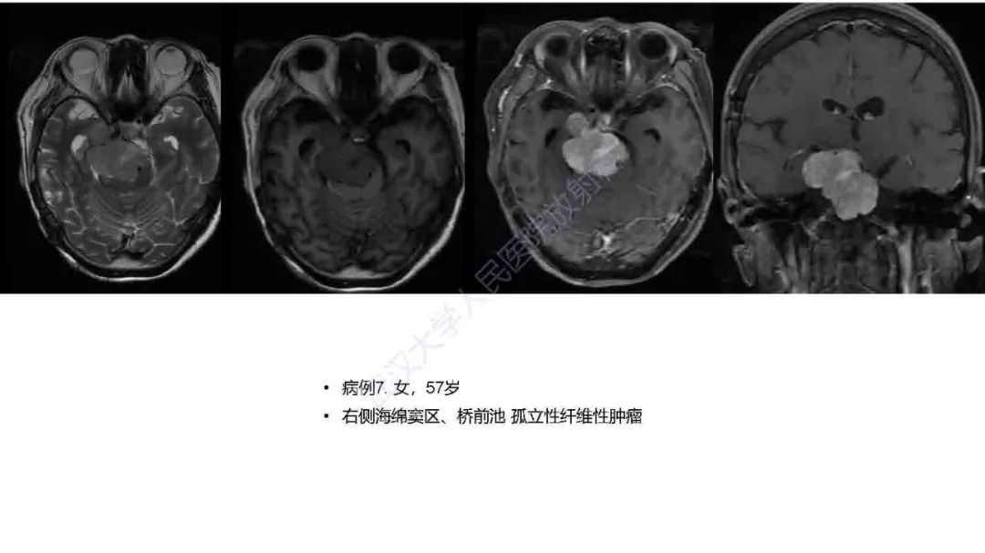 影像PPT - 【PPT】脑室孤立性纤维性肿瘤影像诊断-19