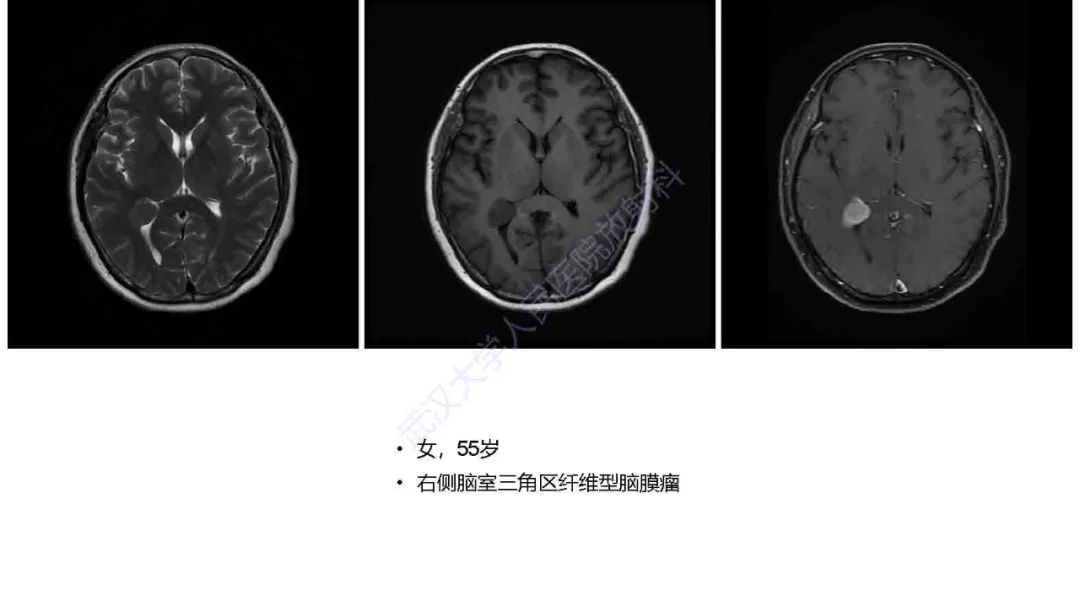 影像PPT - 【PPT】脑室孤立性纤维性肿瘤影像诊断-23