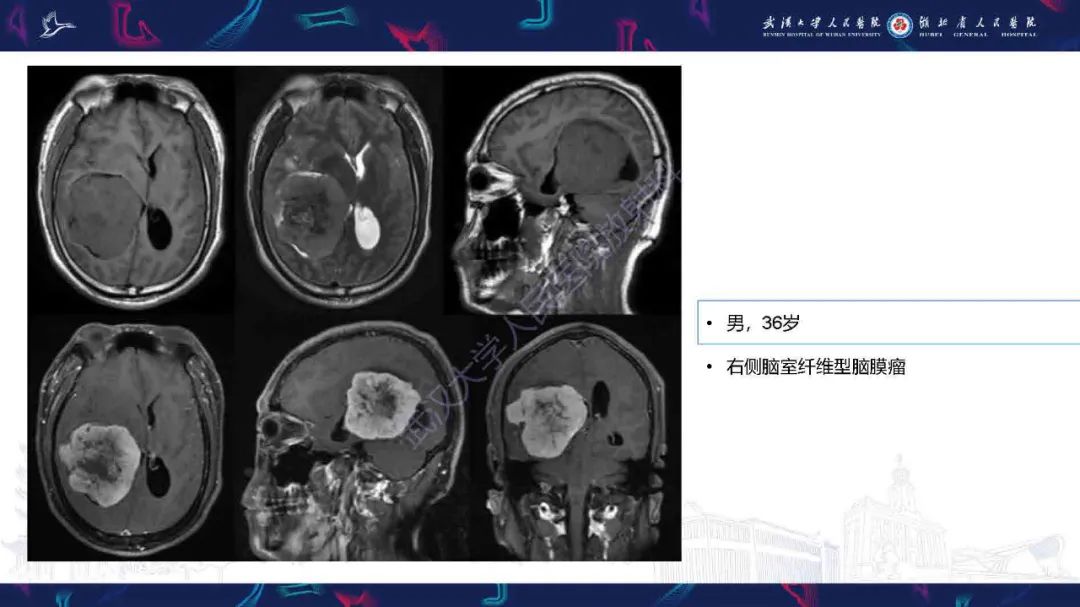 影像PPT - 【PPT】脑室孤立性纤维性肿瘤影像诊断-24