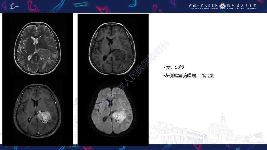 影像PPT - 【PPT】脑室孤立性纤维性肿瘤影像诊断-25