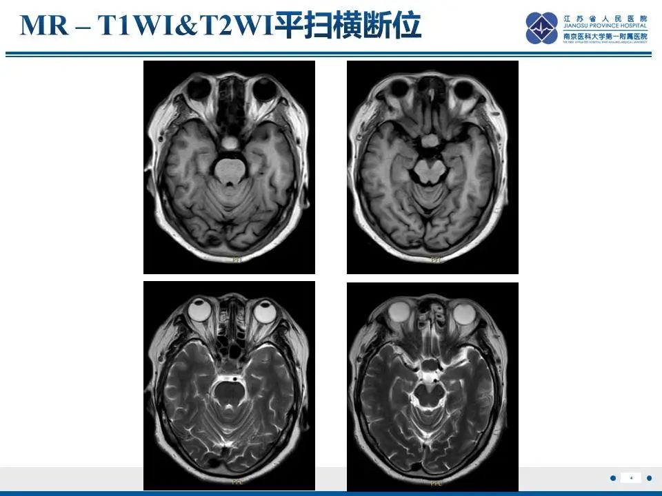 影像PPT - 【PPT】神经垂体颗粒细胞瘤-5