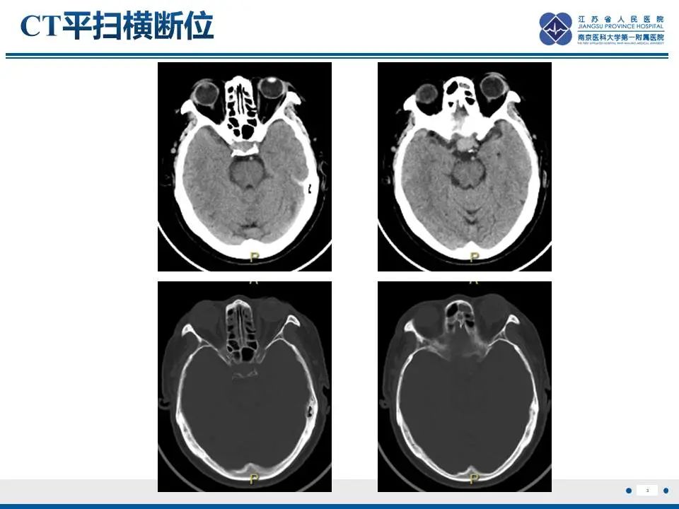 影像PPT - 【PPT】神经垂体颗粒细胞瘤-4