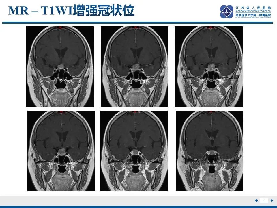 影像PPT - 【PPT】神经垂体颗粒细胞瘤-8