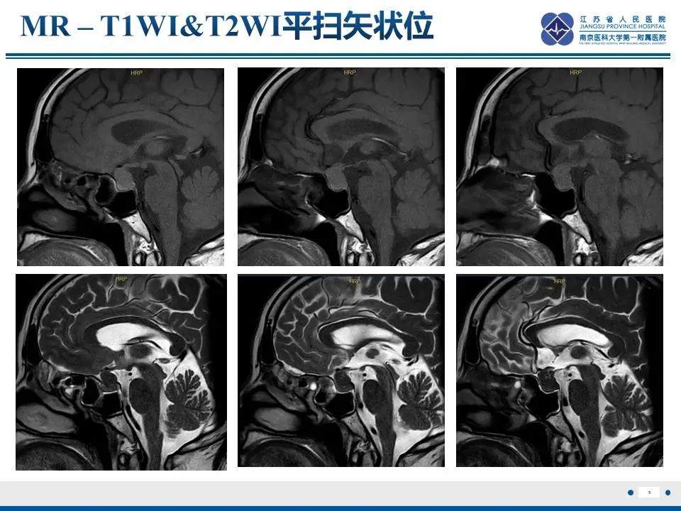 影像PPT - 【PPT】神经垂体颗粒细胞瘤-6