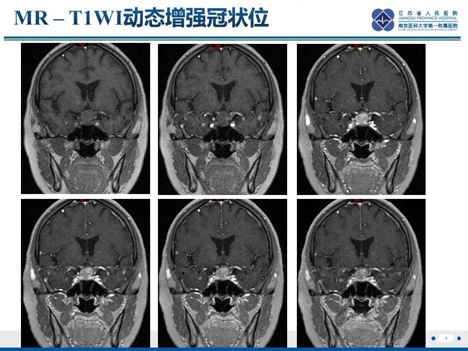 影像PPT - 【PPT】神经垂体颗粒细胞瘤-7