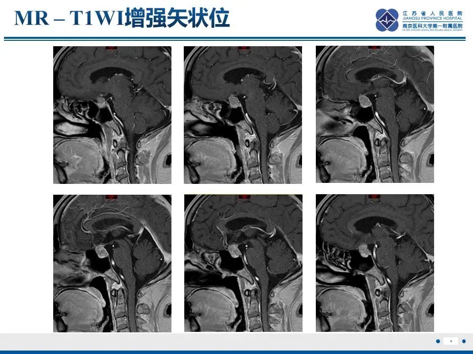 影像PPT - 【PPT】神经垂体颗粒细胞瘤-9