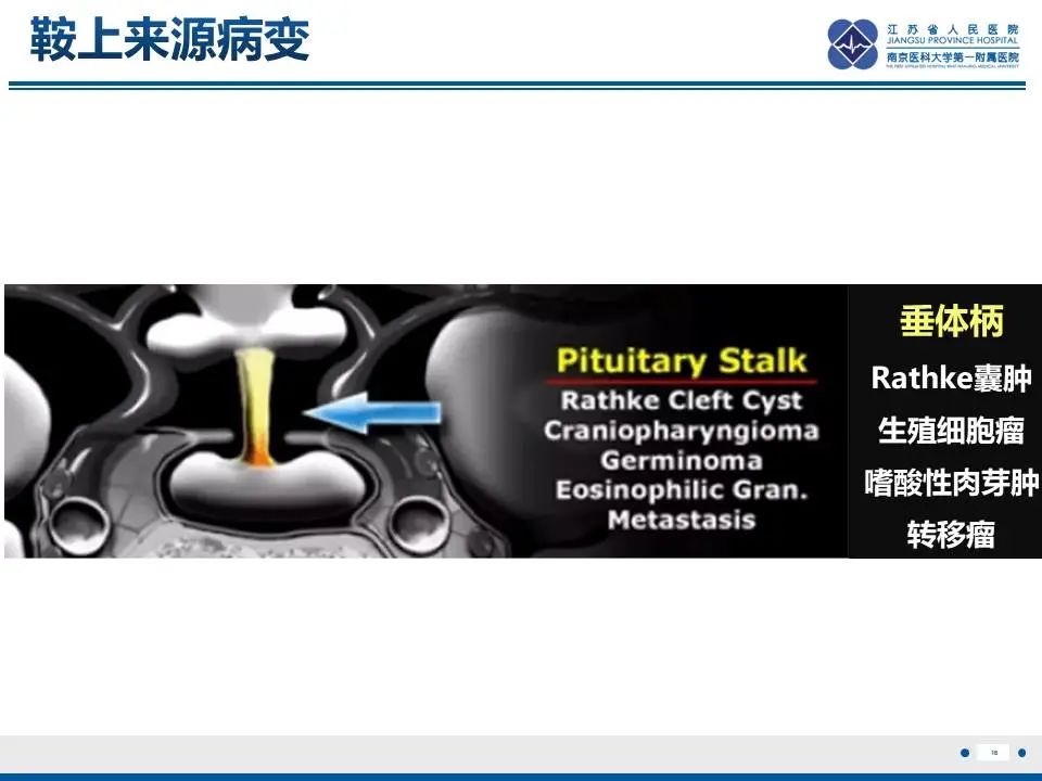 影像PPT - 【PPT】神经垂体颗粒细胞瘤-17