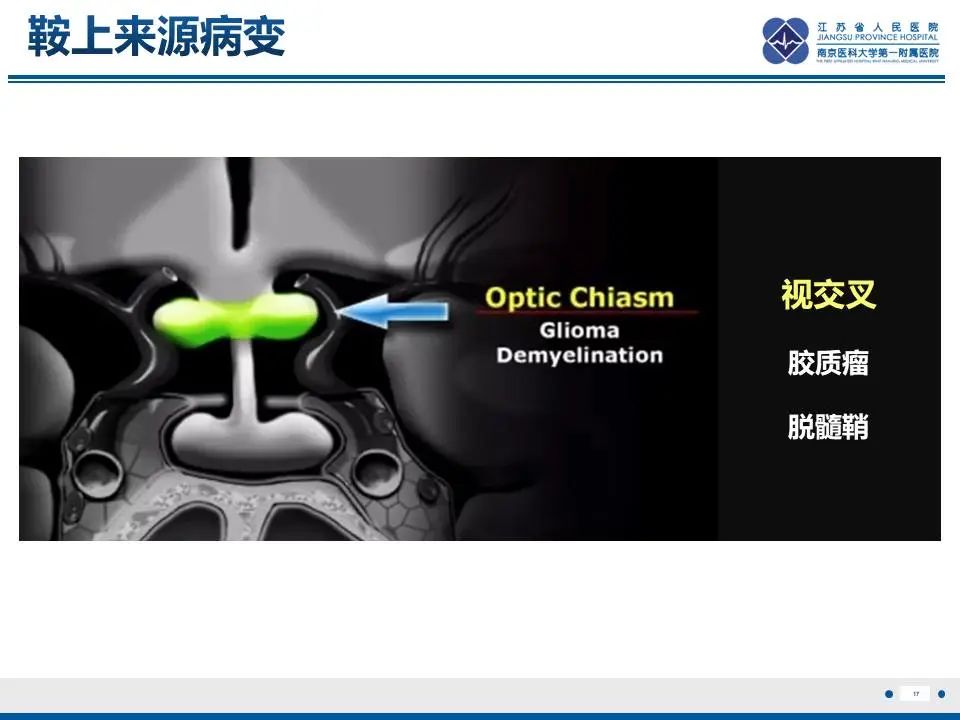 影像PPT - 【PPT】神经垂体颗粒细胞瘤-18