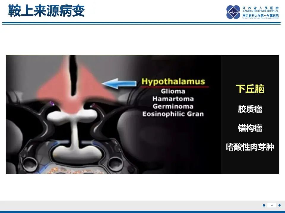 影像PPT - 【PPT】神经垂体颗粒细胞瘤-19