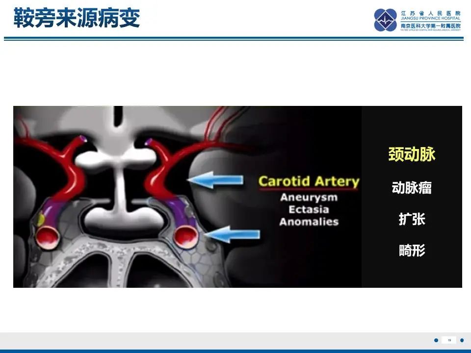影像PPT - 【PPT】神经垂体颗粒细胞瘤-20