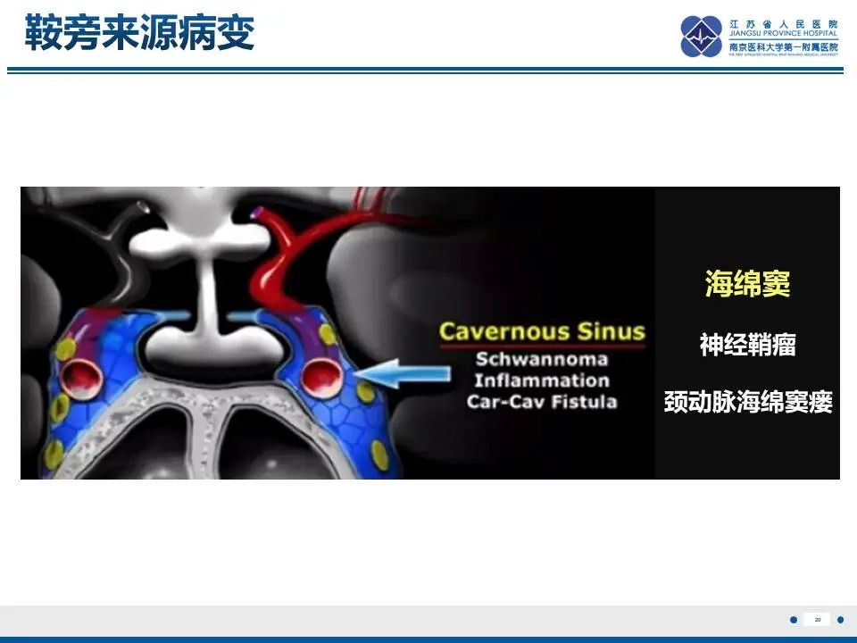 影像PPT - 【PPT】神经垂体颗粒细胞瘤-21