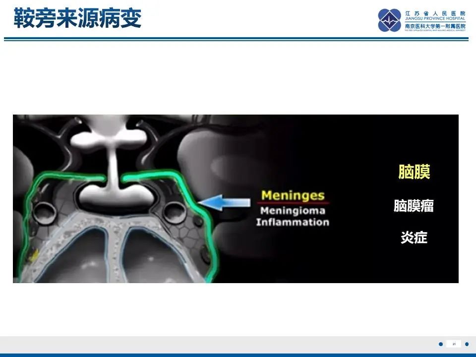 影像PPT - 【PPT】神经垂体颗粒细胞瘤-22