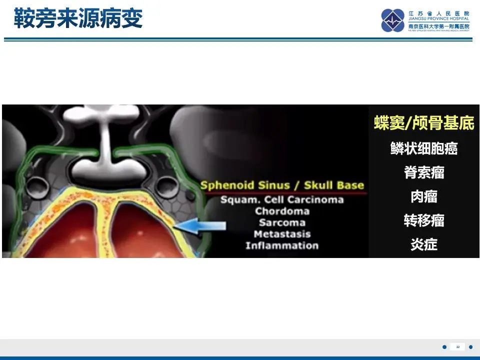 影像PPT - 【PPT】神经垂体颗粒细胞瘤-23