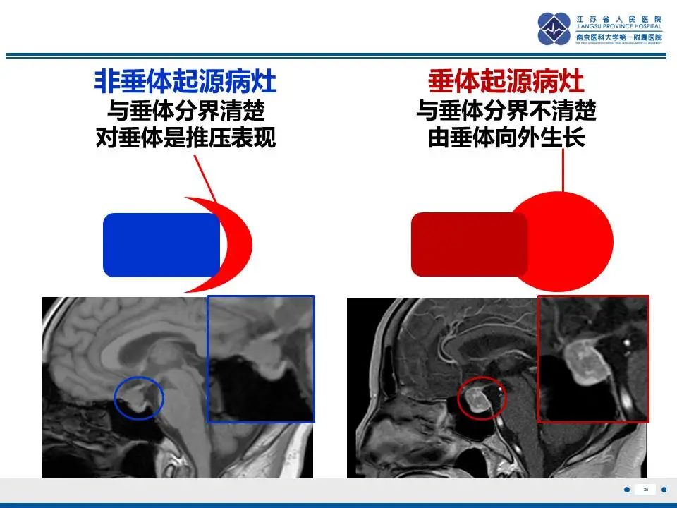 影像PPT - 【PPT】神经垂体颗粒细胞瘤-26