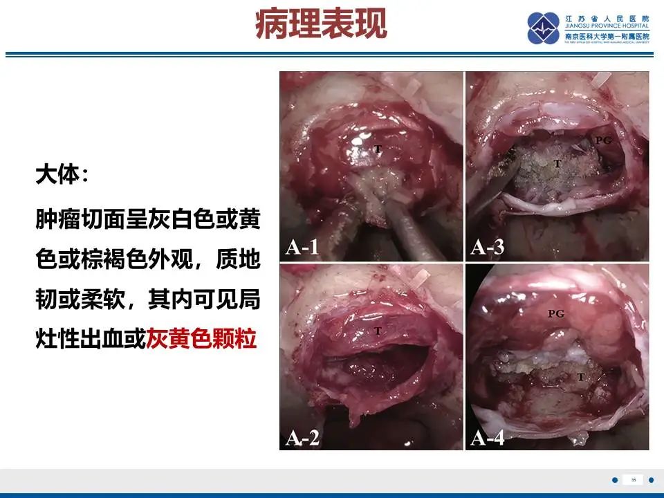 影像PPT - 【PPT】神经垂体颗粒细胞瘤-36