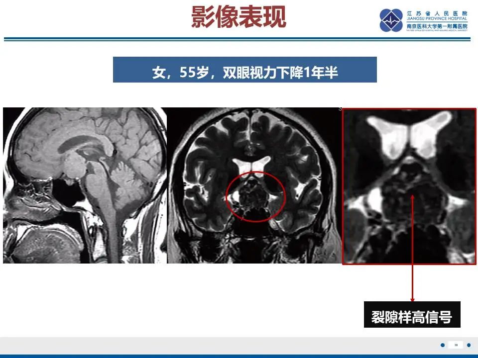 影像PPT - 【PPT】神经垂体颗粒细胞瘤-40