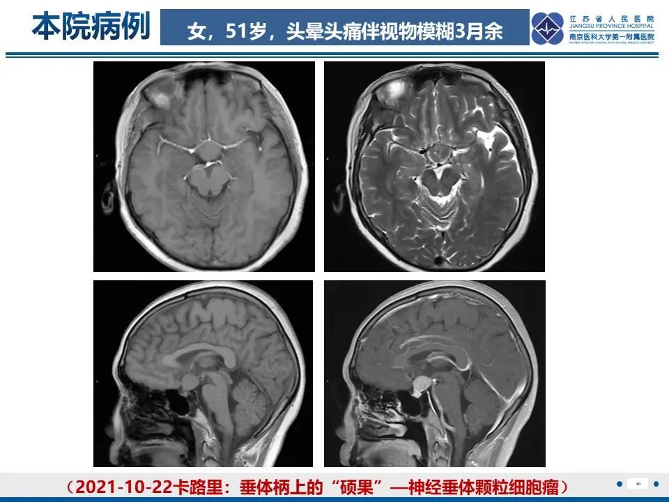 影像PPT - 【PPT】神经垂体颗粒细胞瘤-41