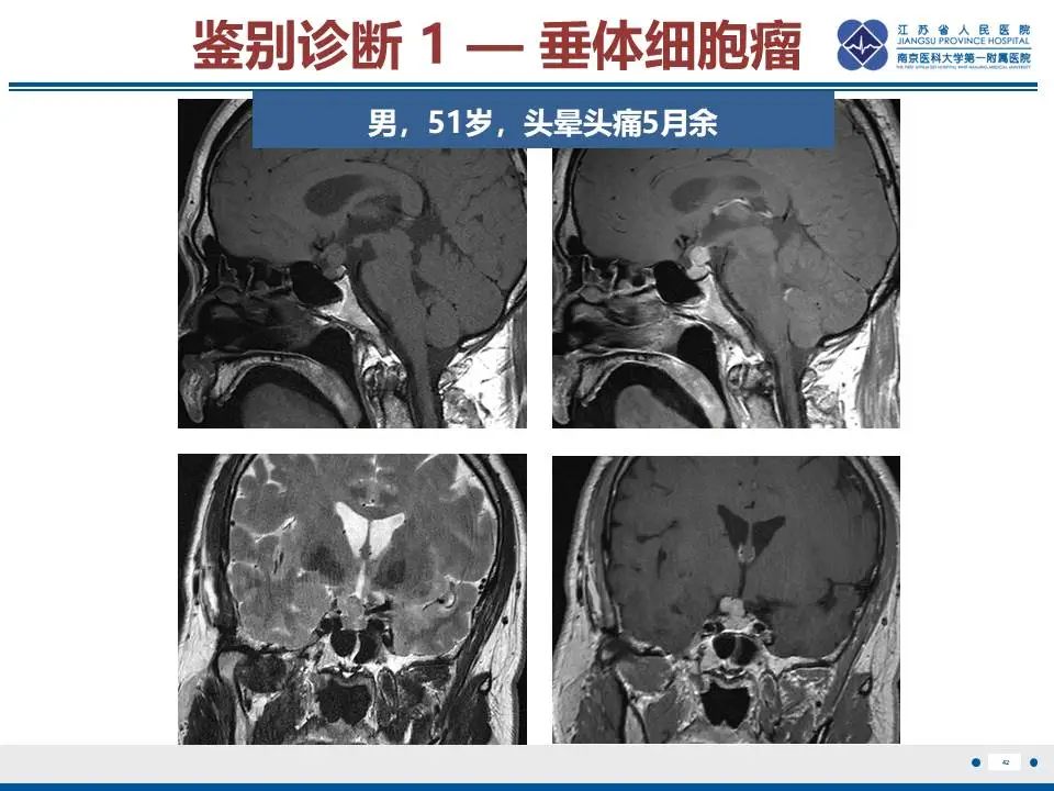 影像PPT - 【PPT】神经垂体颗粒细胞瘤-43