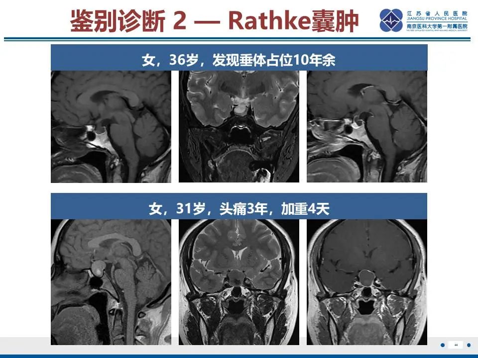 影像PPT - 【PPT】神经垂体颗粒细胞瘤-45