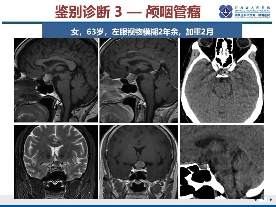影像PPT - 【PPT】神经垂体颗粒细胞瘤-47