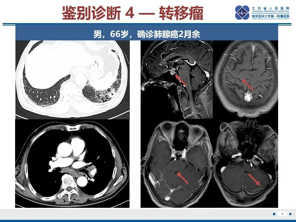 影像PPT - 【PPT】神经垂体颗粒细胞瘤-49