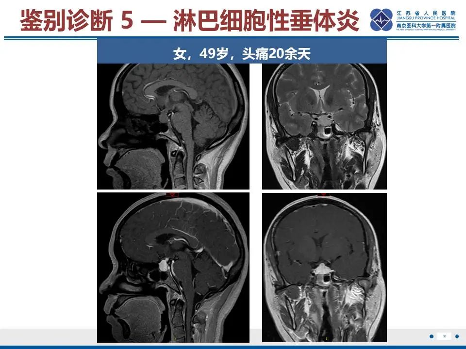 影像PPT - 【PPT】神经垂体颗粒细胞瘤-51