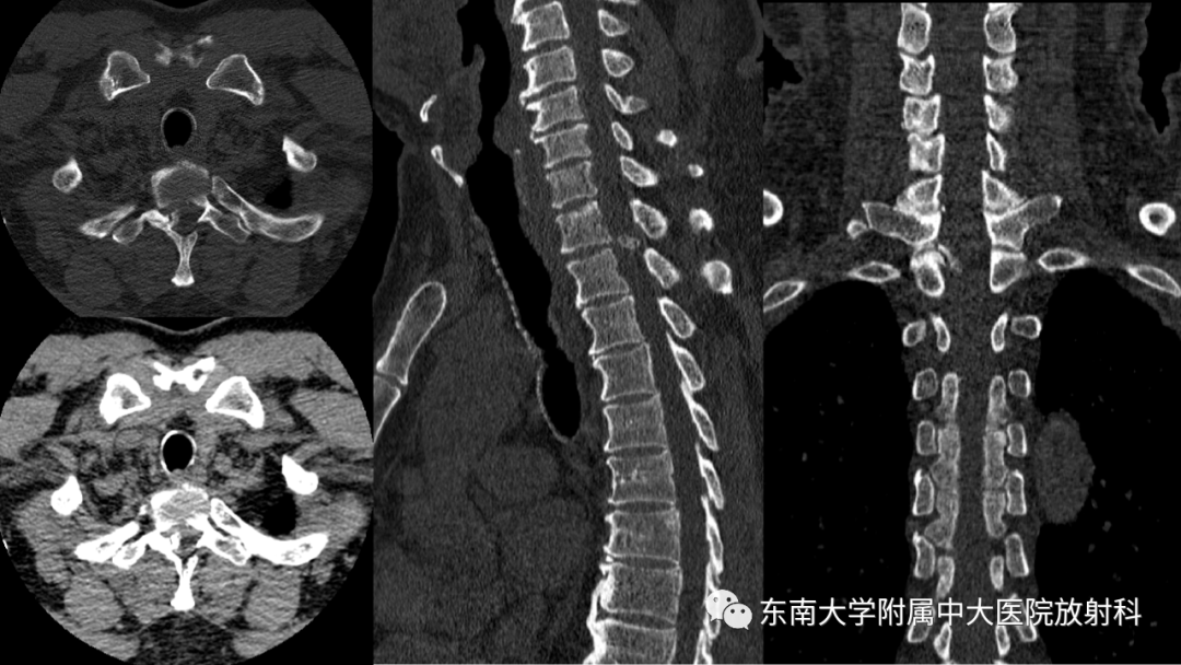 影像PPT - 【PPT】脊柱骨软骨瘤-1