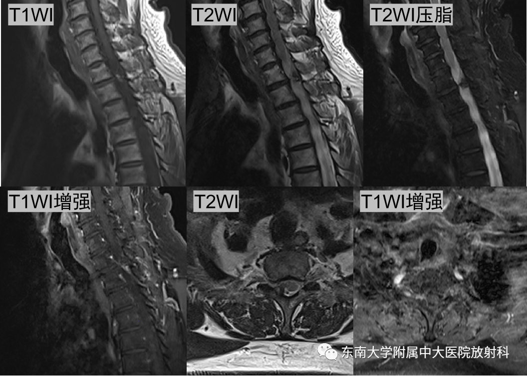影像PPT - 【PPT】脊柱骨软骨瘤-2