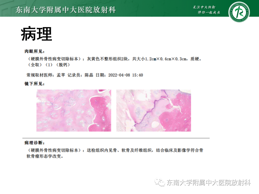 影像PPT - 【PPT】脊柱骨软骨瘤-4