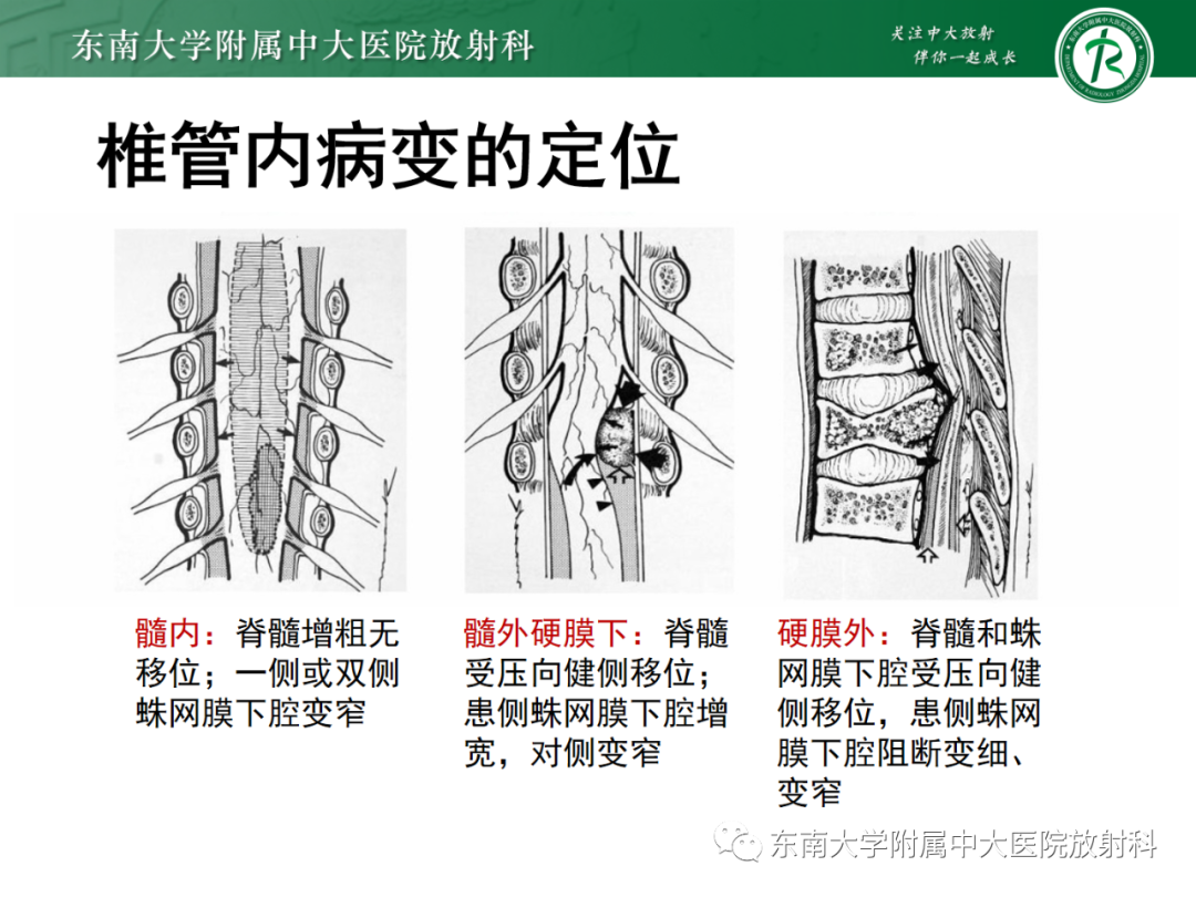 影像PPT - 【PPT】脊柱骨软骨瘤-9