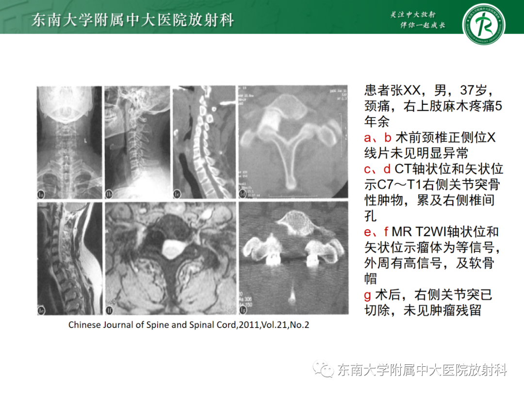 影像PPT - 【PPT】脊柱骨软骨瘤-13