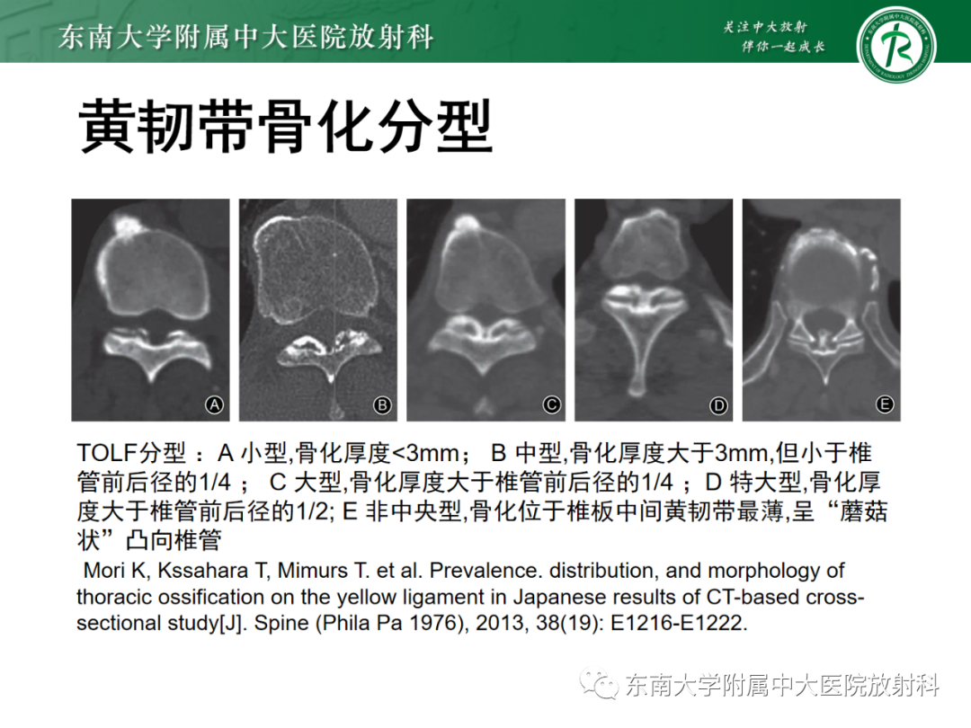 影像PPT - 【PPT】脊柱骨软骨瘤-17