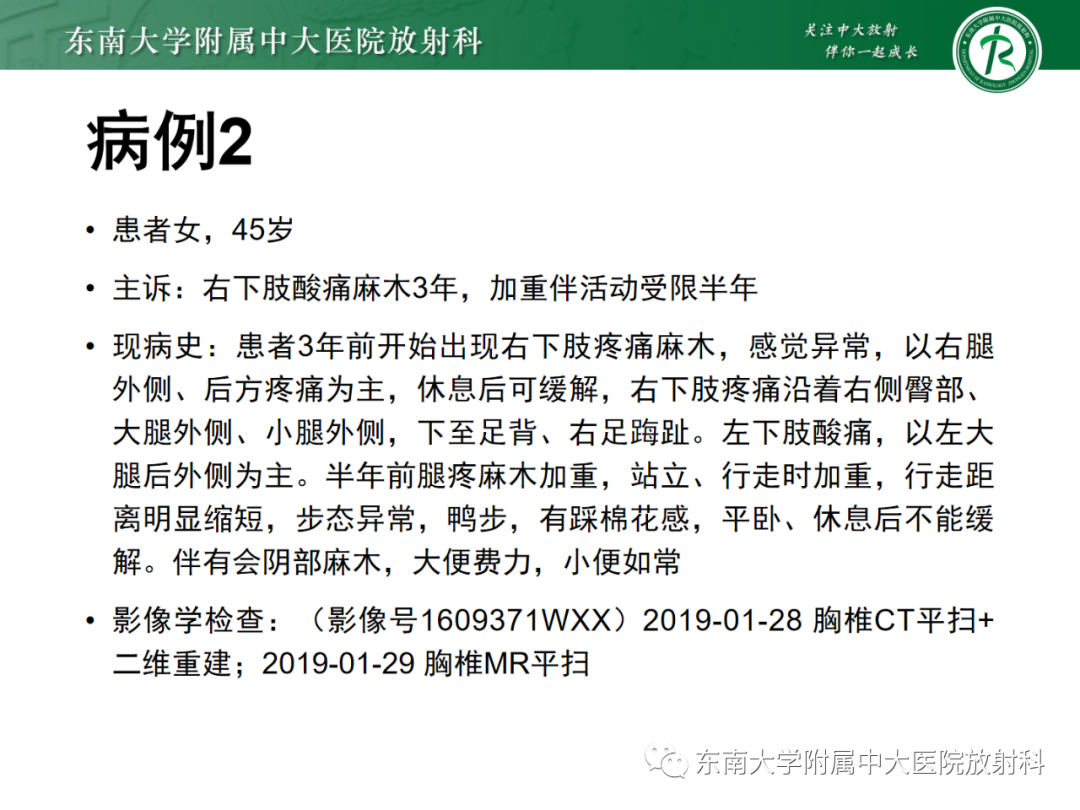 影像PPT - 【PPT】脊柱骨软骨瘤-18