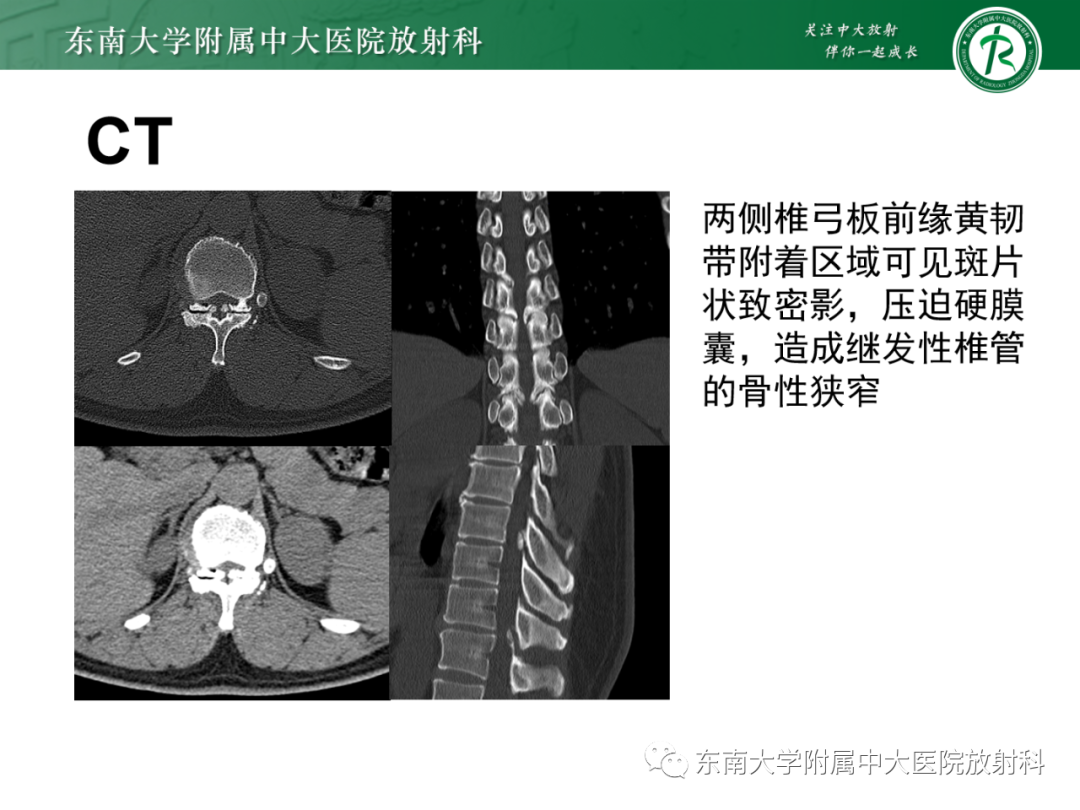 影像PPT - 【PPT】脊柱骨软骨瘤-19