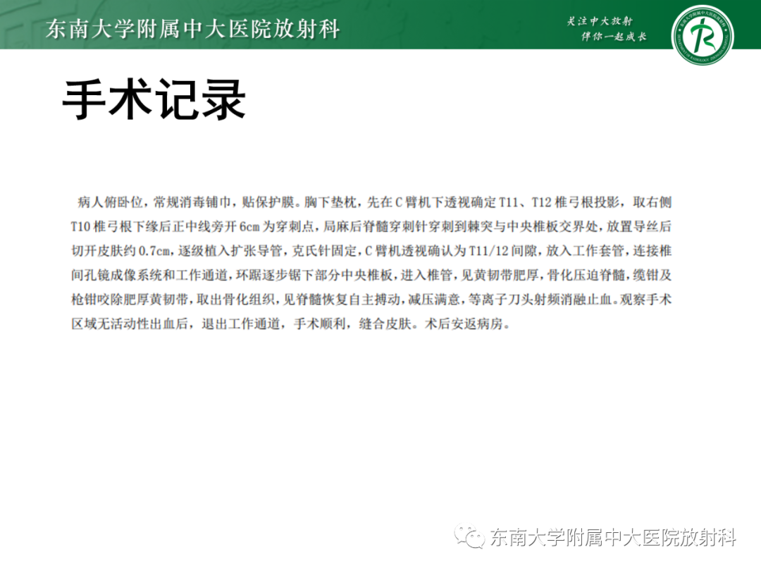 影像PPT - 【PPT】脊柱骨软骨瘤-21